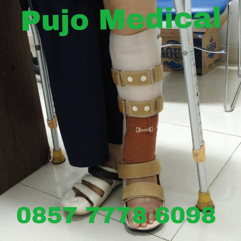 Jasa pembuatan kaki palsu Karawang PUJO MEDICAL