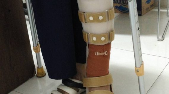 Harga Kaki Palsu Bandung