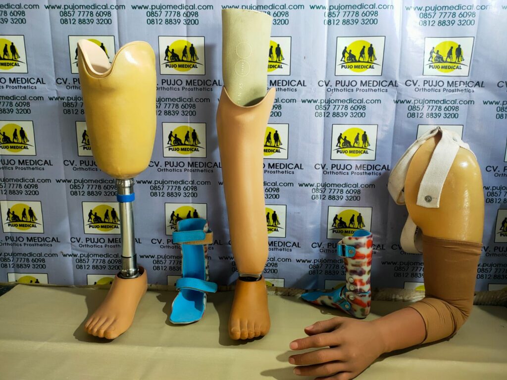 Jasa pembuatan kaki palsu Tasik PUJO MEDICAL